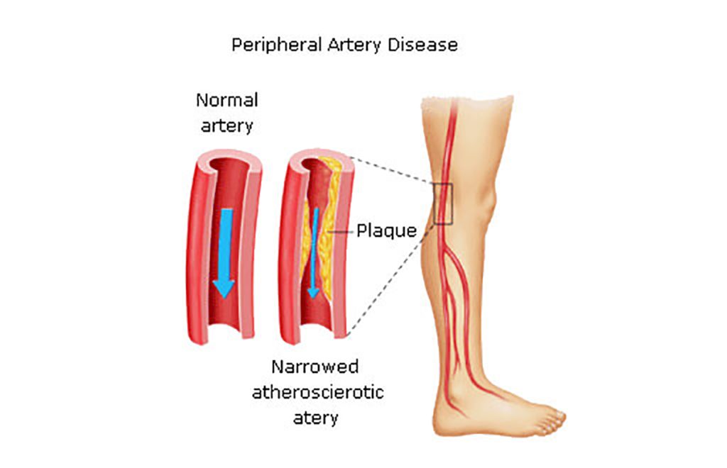 Peripheral Vascular Disease