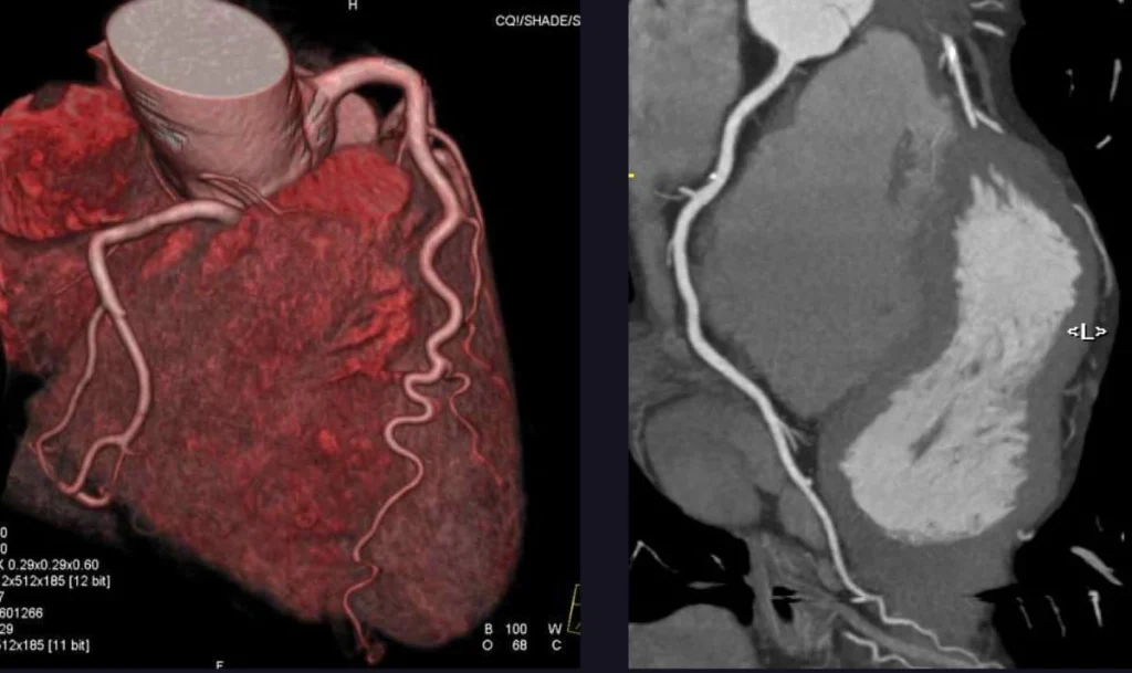 CT Coronary Angiography results