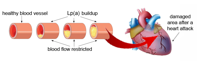 Lipoprotein in the blood vessels and it impact on body