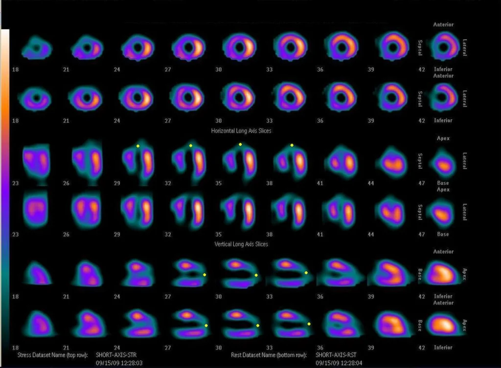 Myocardial Perfusion Imaging results