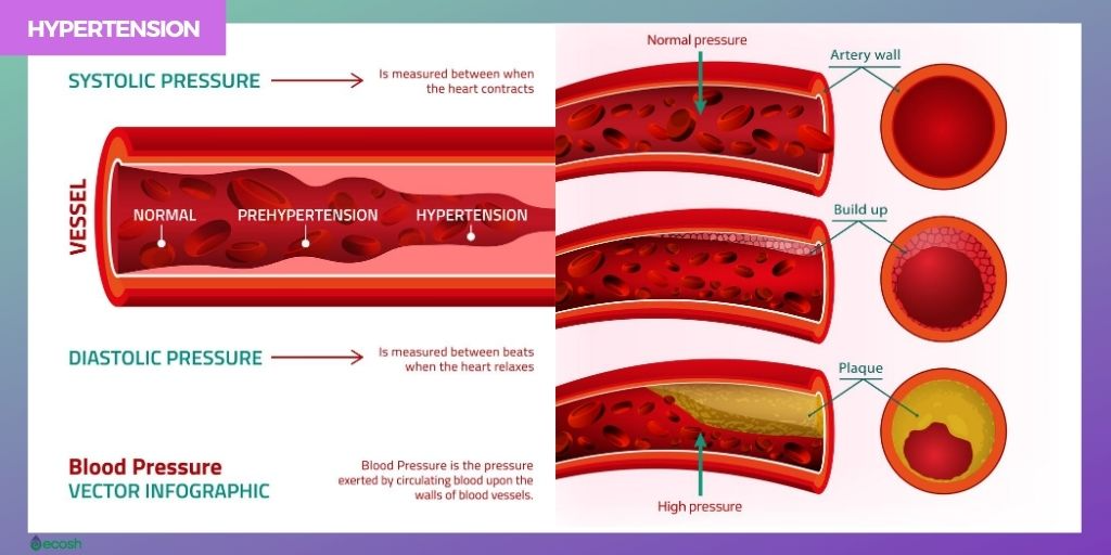 Secondary Hypertension and its main causes