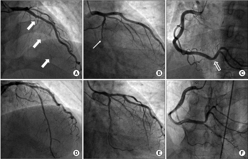 coronary angiography test detection results