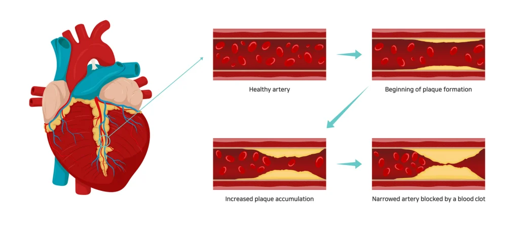 Atherosclerosis infected artery and healthy artery