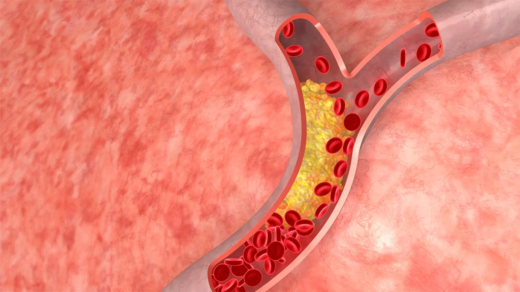 High cholesterol causes and effects on health