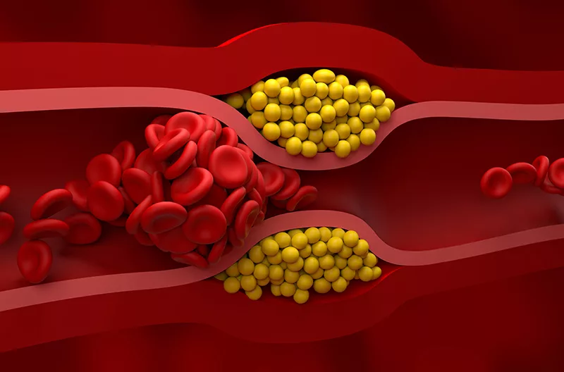 Effect of high Cholesterol level on body