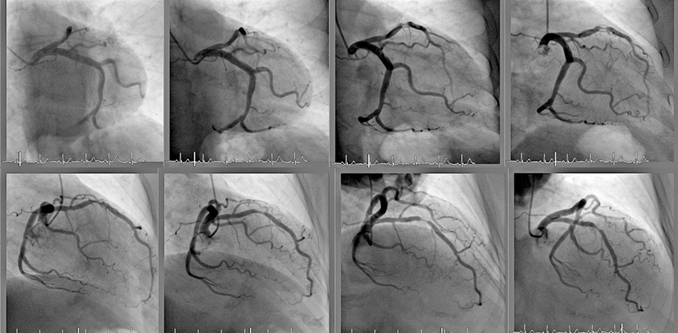 Series of eight grayscale coronary angiogram images showing various views of blood vessels in the heart, along with ECG readings.