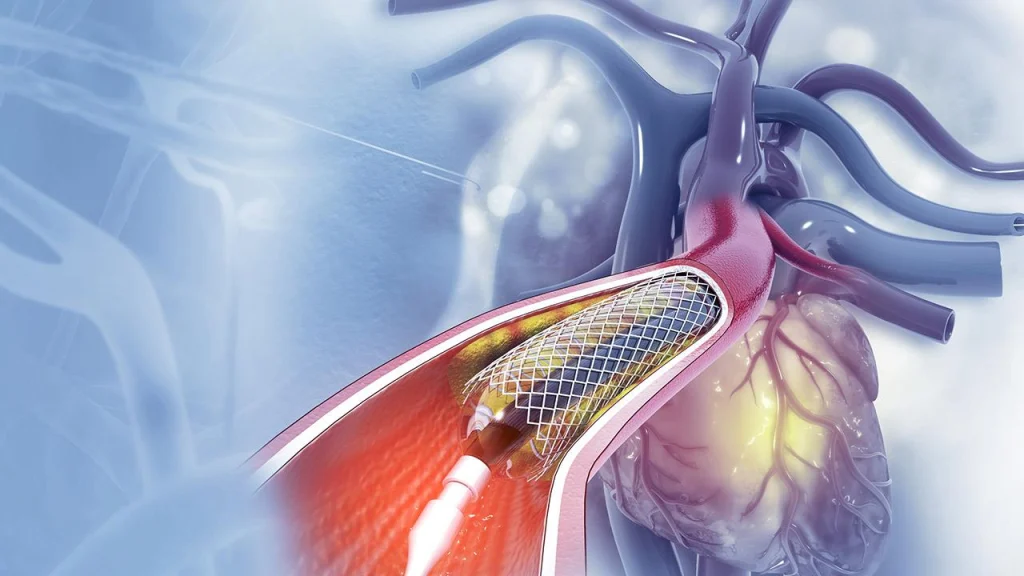 Illustration of a heart and artery with a stent inserted to treat blockage, highlighting cardiovascular health and medical intervention. angioplasty procedure.