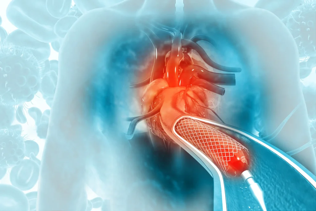 Digital illustration of a heart with a catheter inserted, surrounded by abstract representations of cells and blood vessels. angioplasty procedure