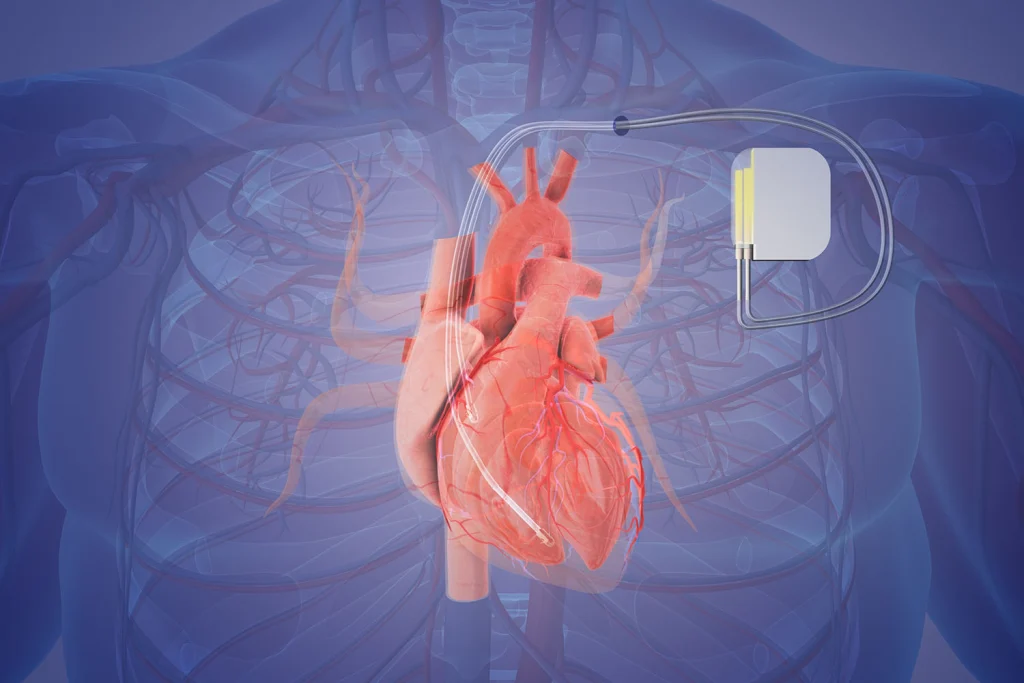 Digital illustration of a human heart with an implanted medical device, shown within a transparent circulatory system, used by American Medical Center in Dubai for patient education.