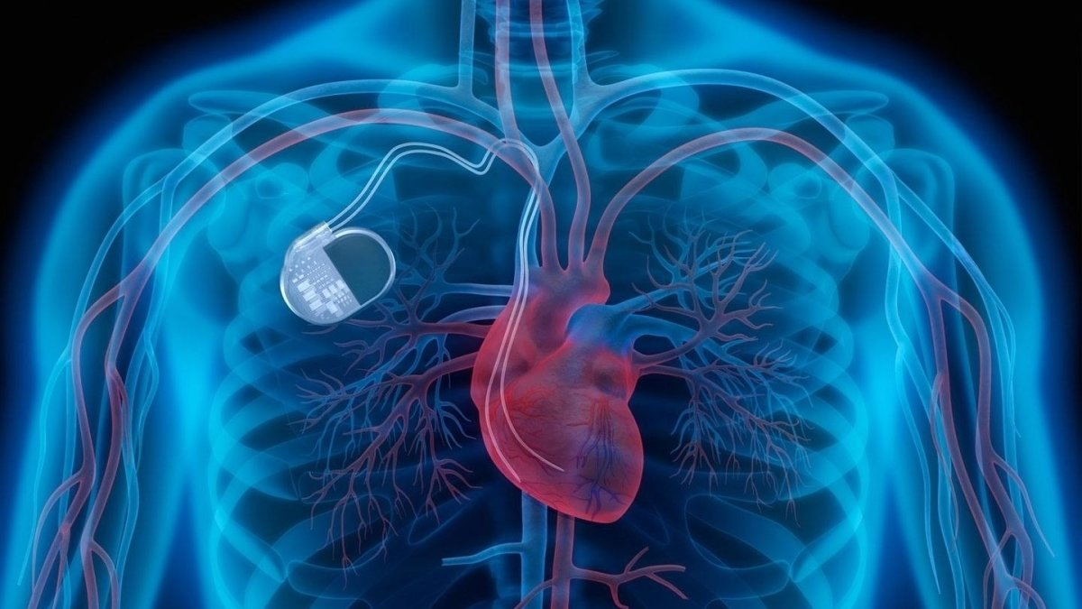 Medical illustration of a human torso showing the heart, blood vessels, and an implanted cardiac device, patient monitoring at American Medical Heart Center in Dubai.